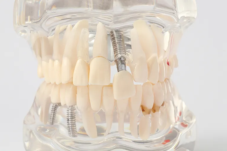 インプラント治療