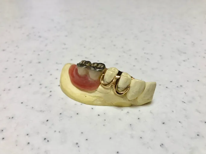 アタッチメント義歯